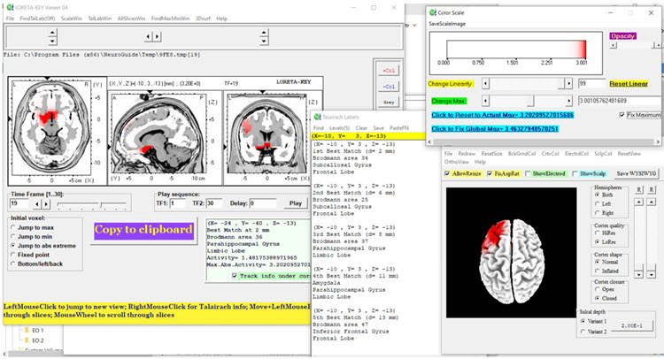 Figure 6 - Baseline eyes-closed z-score LORETA analysis for 19 Hz
